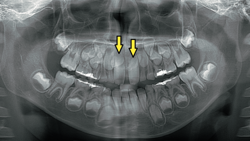 正中埋伏過剰歯 - Dental Note