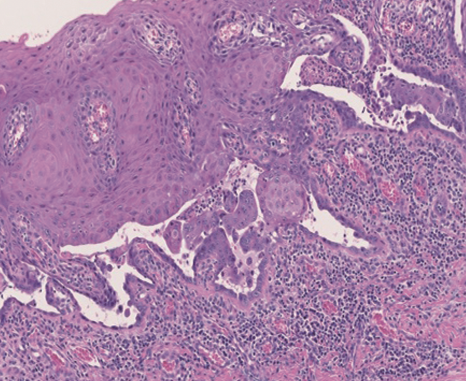 尋常性天疱瘡（PV：pemphigus vulgaris） - Dental Note