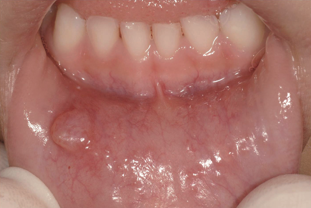 唾液腺生検の準備